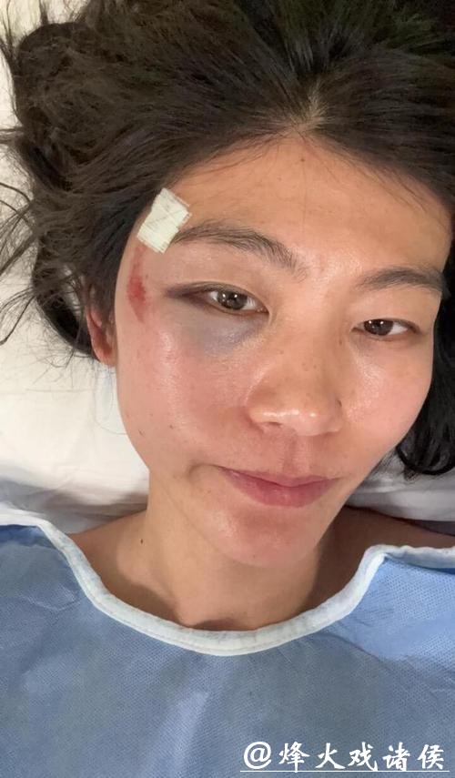 头部冲下摔倒缝一针,刘佳宇报平安,发生了什么? 头部冲下摔倒缝一针,刘佳宇报平安,发生了什么?